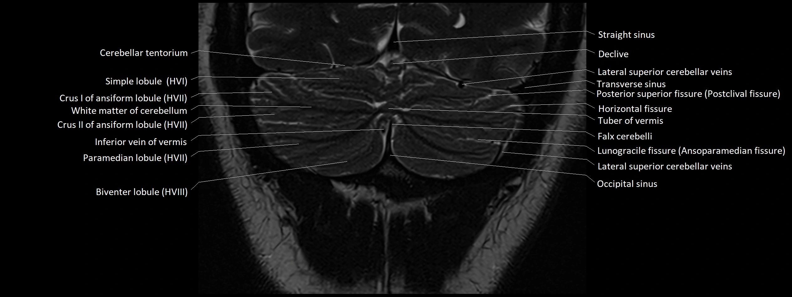 Anatomy of cerebellum coronal cross sectional 3T image 25.webp